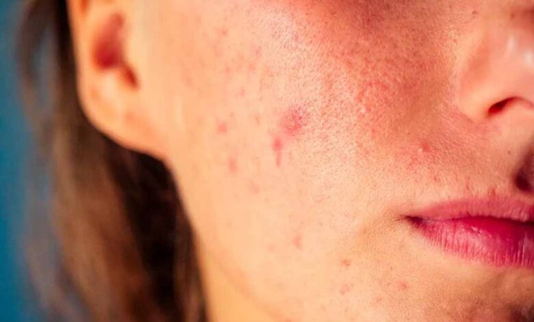 गर्मी में तैलीय त्वचा दे सकती है मुहांसे, जानें 5 टिप्स