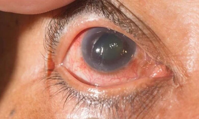 किसी को भी हो सकती है आंखों की बीमारी काला मोतिया