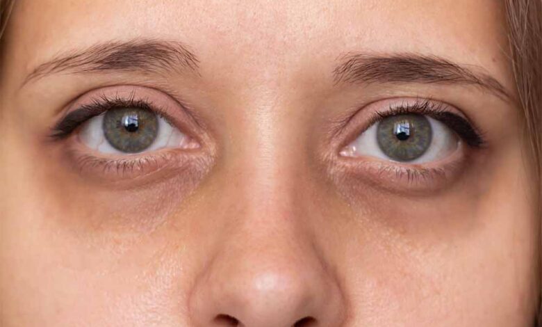 आंखों के नीचे के काले घेरे इस नुस्खे से हो जाएंगे छूमंतर