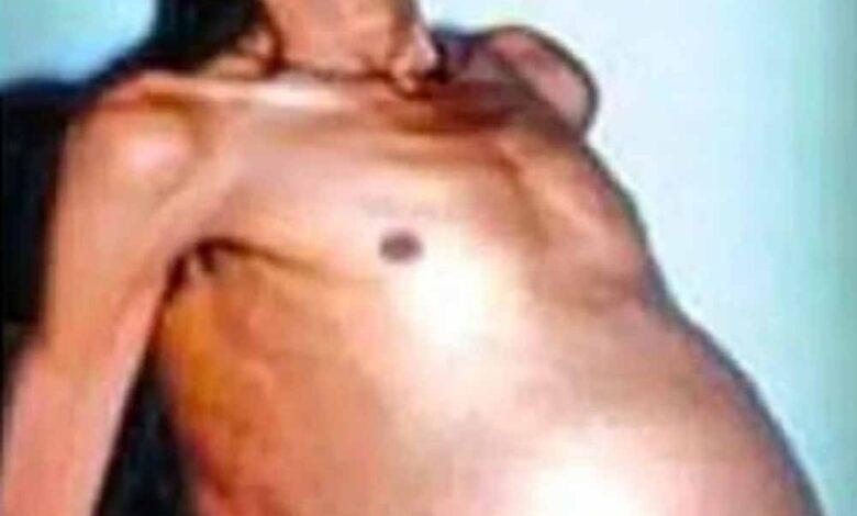 36 साल तक पेट में छिपे रहे जुड़वा भ्रूण, डॉक्टर भी रह गए हैरान