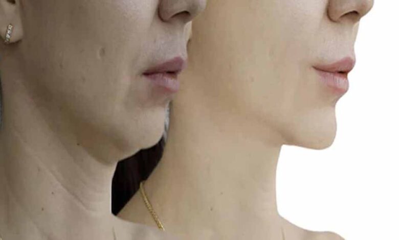 सिर्फ 5 मिनट में हटाएं गर्दन की झुर्रियाँ – उम्र बढ़ने पर भी बनी रहे स्किन टाइट