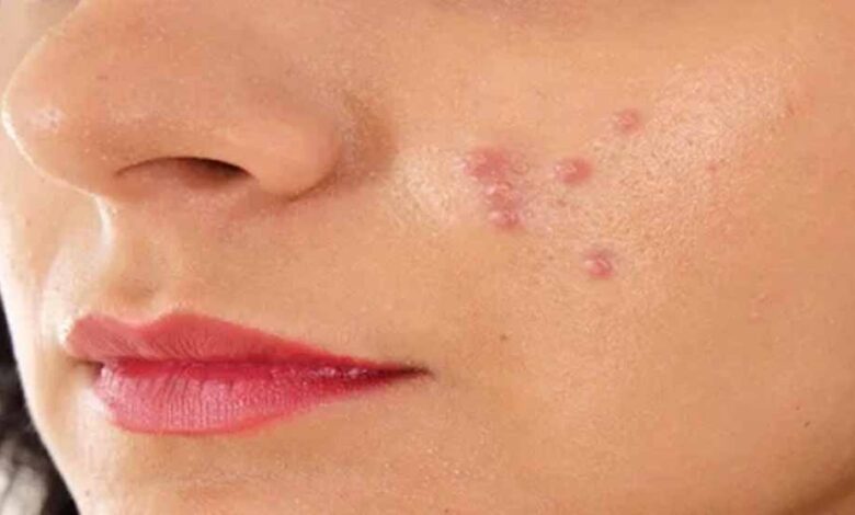 अब इन आसान तरीकों से दूर करें मुहांसे – Khabar Jagat