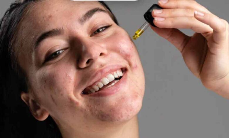 सैलिसिलिक एसिड का कमाल! पिंपल्स और दाग-धब्बों से मिलेगा झटपट छुटकारा